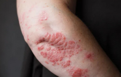 湿疹对人体会造成哪些危害?